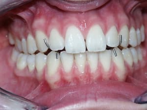 Rimavecplaque neicit - Eugenol