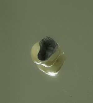 Radicular amputation 1  3  if5b7t - Eugenol