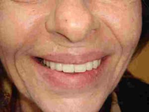 Vidal implants 014 yopfot - Eugenol