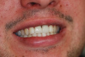 Zircone profil iuuyod - Eugenol