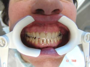 Acro1 fluxs4 - Eugenol