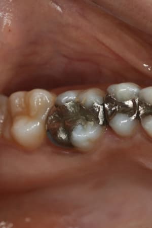 Amalgame oi7b7l - Eugenol