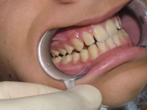 Amelog imp 1 b1zrho - Eugenol