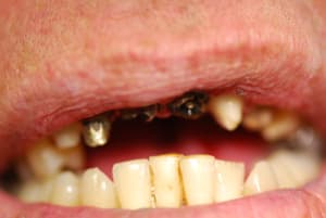 Anterieure prepas post depose od3mqu - Eugenol