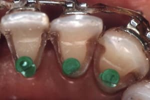 Attelle  3  tid8e2 - Eugenol