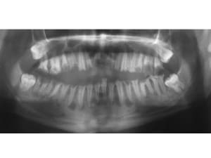 Bouche pourrie cuvept - Eugenol