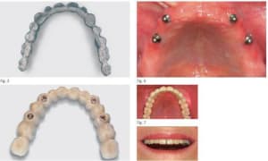 Bridge amovible sur dalbo e7xybq - Eugenol