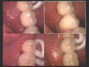 Bridge céramique sur zircone dense scellé sur implants 37  36 et 35 ai98vg - Eugenol