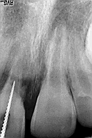 Broche lpbl4w - Eugenol