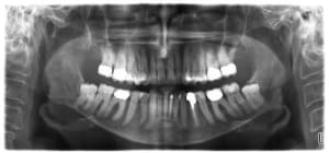 Cbct1 reyjfm - Eugenol