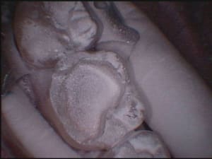 Cerec4 idk2de - Eugenol
