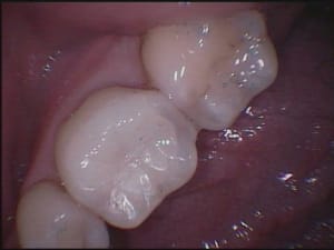 Cerec5 yelvw5 - Eugenol