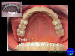 Cicatrisation gingivale suite eimci positdental 19 dq2jus - Eugenol