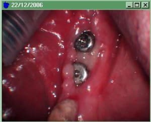 Complication xmcj2a - Eugenol