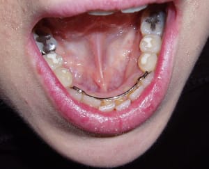 Contention hslfim - Eugenol