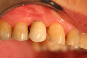 Couronne l00w4m - Eugenol