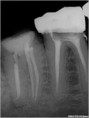Crochet apical 4 xlxnbt - Eugenol