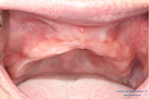 Déoulé d une mci dr r - Eugenol