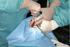 Déoulé d une mci dr r - Eugenol