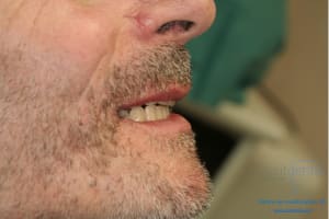 Déoulé d une mci dr r - Eugenol