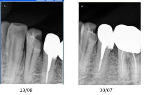 Dent abces fdicbl - Eugenol