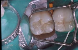 Dentine eyywvf - Eugenol