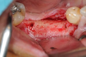 Dentiste implant mondelange h19cmf - Eugenol
