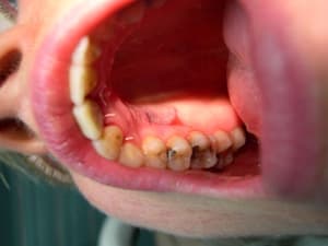 Dents1 030 lhtede - Eugenol