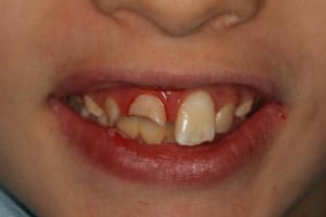 Dents fractur es hnjrsj - Eugenol