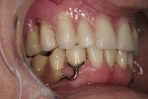 Duidage esthetique 1 rzusir - Eugenol
