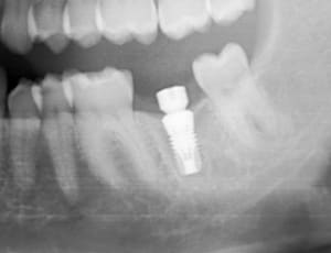 Easyimplant mjxotp - Eugenol