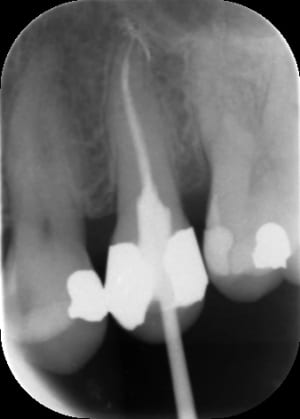 Endo3 qlrsb8 - Eugenol