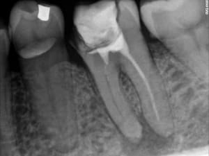 Endo x 1 preop dtfesf - Eugenol