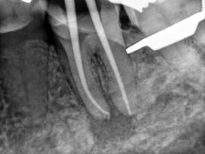 Endo x 2 - Eugenol