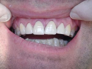 Facettes 2 06 07 2005 23 53 07 l4zjhe - Eugenol