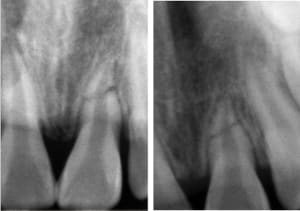 Fracture 21 otunsb - Eugenol