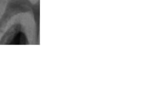 Fracture nhltnn - Eugenol