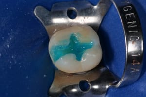 Full etching suaa2k - Eugenol