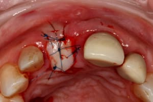 Greffe gingivale tkjs9v - Eugenol