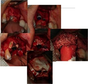 Greffe mixte m9ljqi - Eugenol