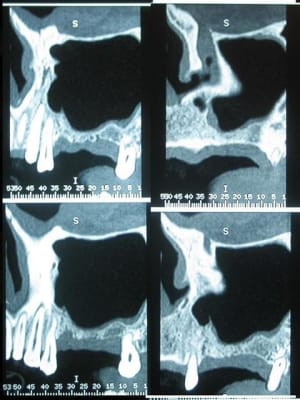 Greffe sinus1 sttrue - Eugenol