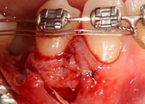 Greffon conjonctif h22esm - Eugenol