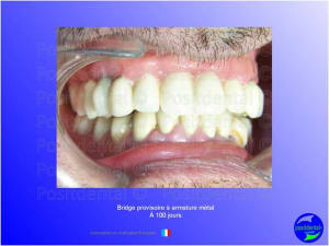 Guide chirurgical   mise en charge imm diate 015 ptfdho - Eugenol