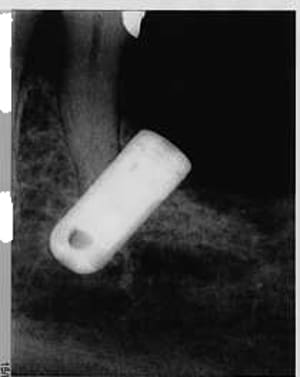 Implant1 bsrjtd - Eugenol