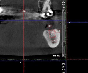 Implant 37 zbdg16 - Eugenol