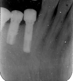 Implant 44 hquvgf - Eugenol