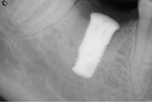 Implant 5 10 k8bmbw - Eugenol