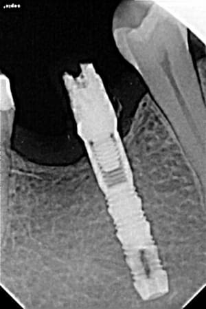 Implant aucpum - Eugenol