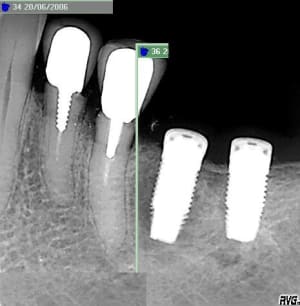 Implant image pas nette l4frwl - Eugenol