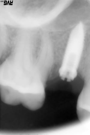 Implant inconnu eihncv - Eugenol